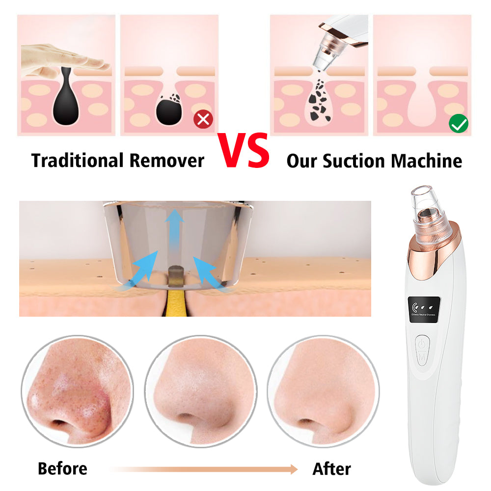 5-in-1 LED Blackhead Suction Device for Deep Pore Cleansing