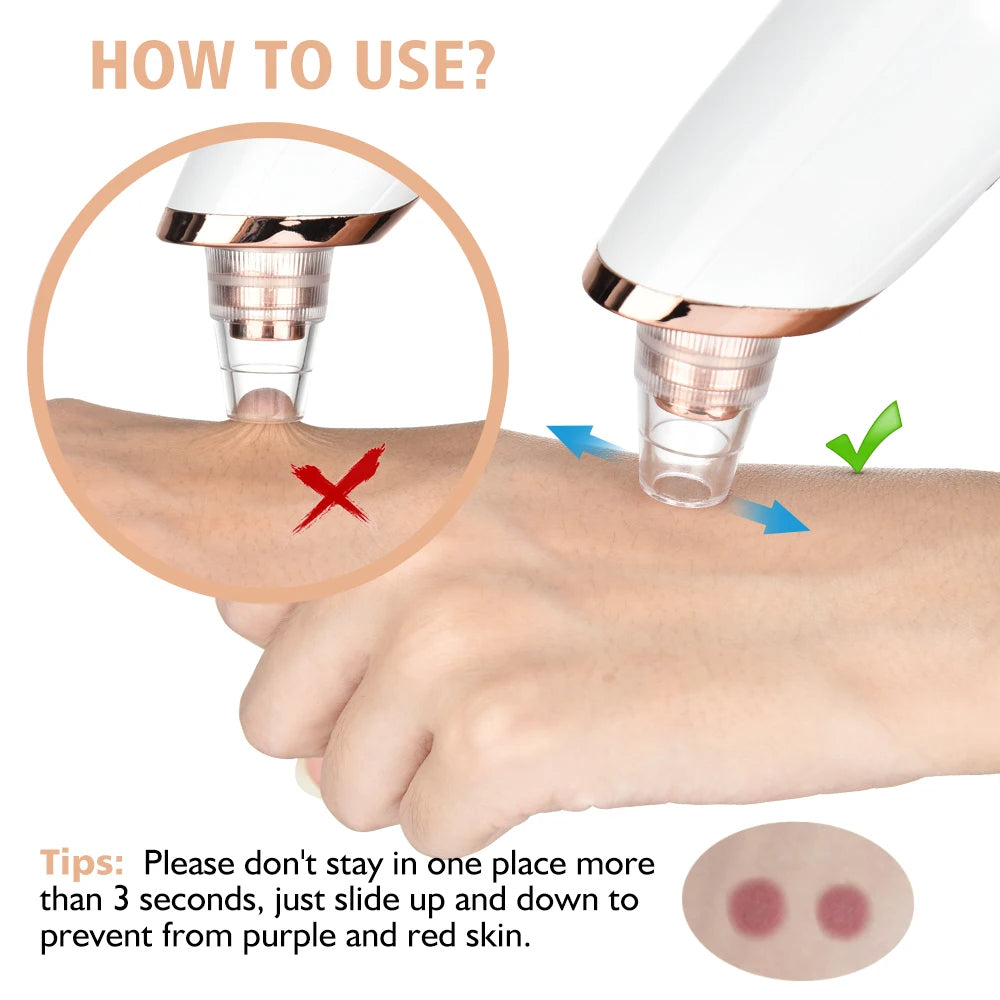 5-in-1 LED Blackhead Suction Device for Deep Pore Cleansing