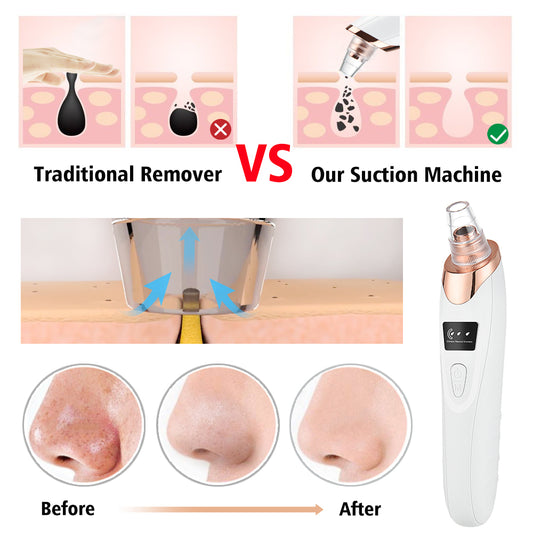5-in-1 LED Blackhead Suction Device for Deep Pore Cleansing